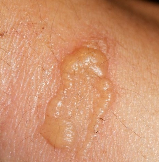Blister on skin caused by exposure to wild parsnip